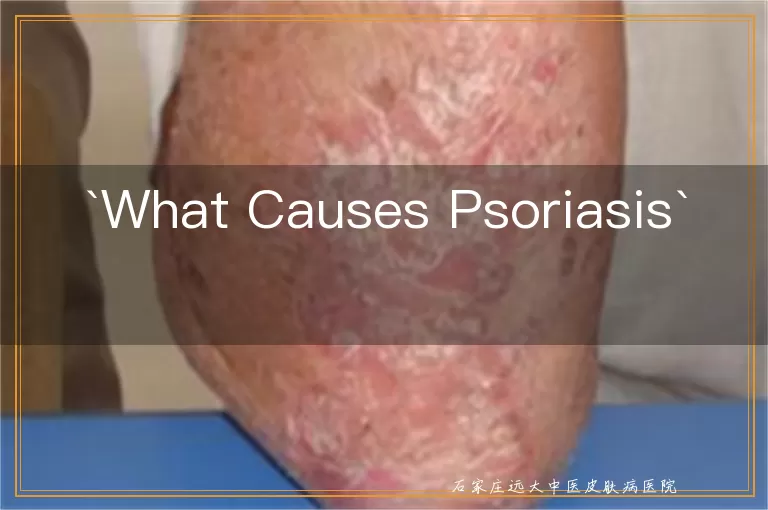 What Causes Psoriasis