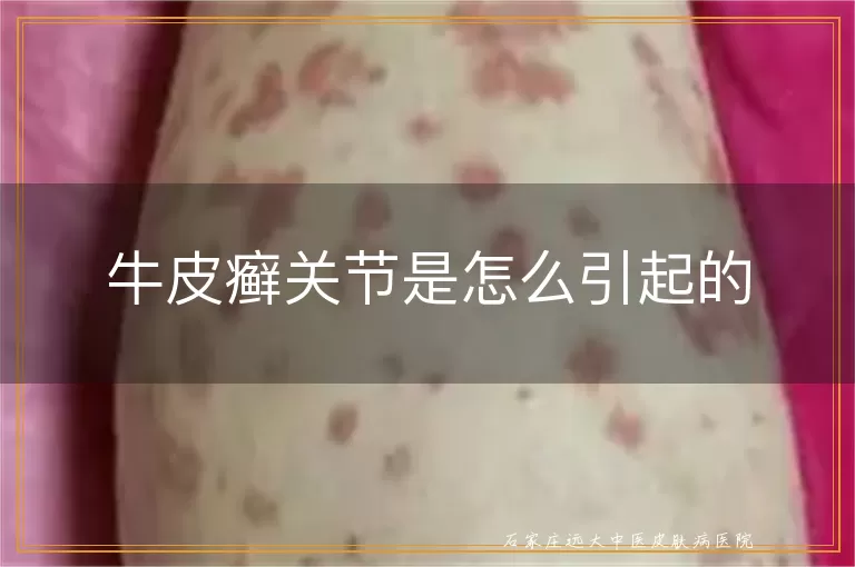 牛皮癣关节是怎么引起的