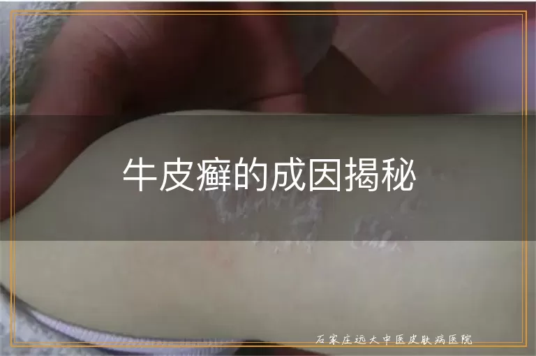 牛皮癣的成因揭秘