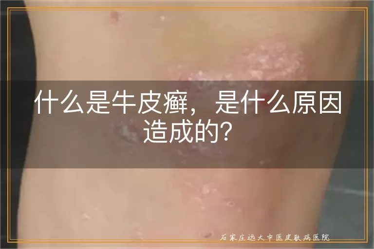 什么是牛皮癣，是什么原因造成的？