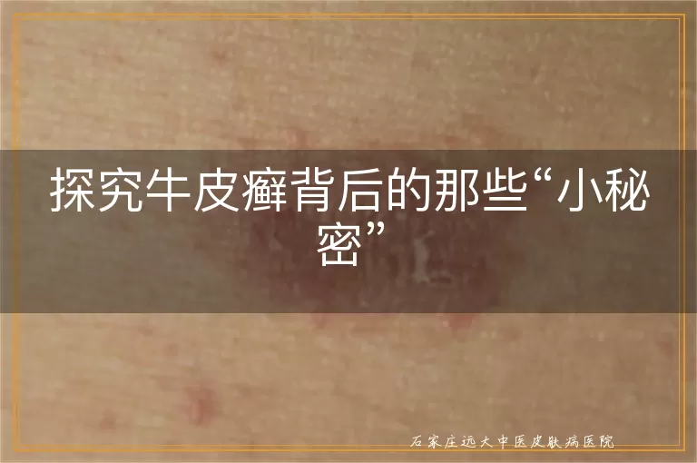 探究牛皮癣背后的那些“小秘密”