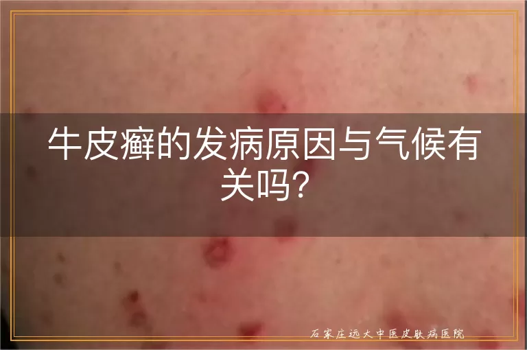 牛皮癣的发病原因与气候有关吗？