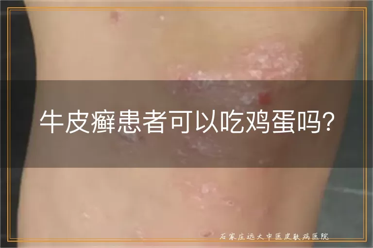 牛皮癣患者可以吃鸡蛋吗？