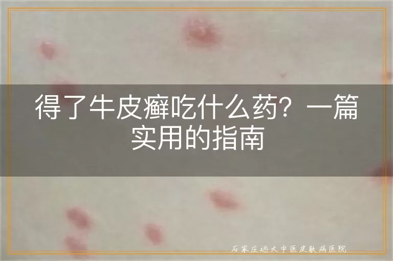 得了牛皮癣吃什么药？一篇实用的指南