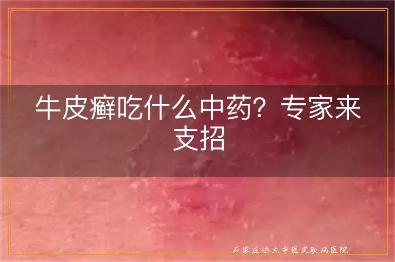 牛皮癣吃什么中药？专家来支招