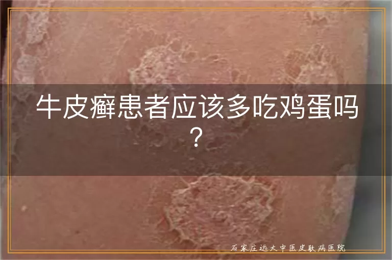 牛皮癣患者应该多吃鸡蛋吗？