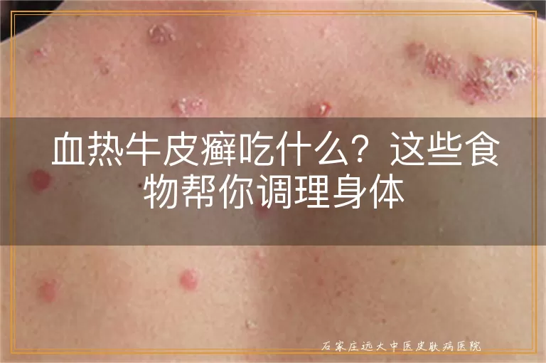 血热牛皮癣吃什么？这些食物帮你调理身体