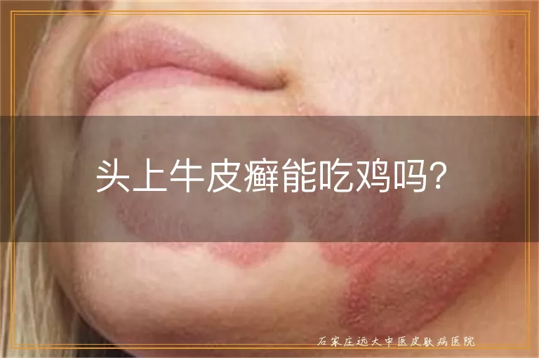 头上牛皮癣能吃鸡吗？