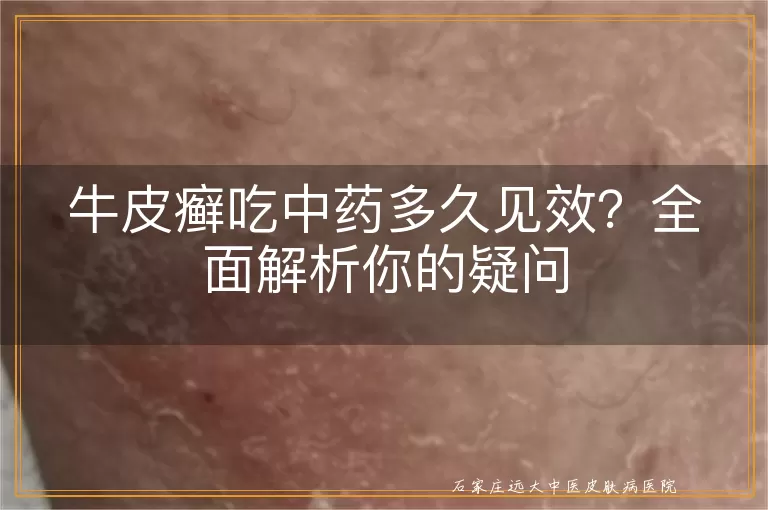 牛皮癣吃中药多久见效？全面解析你的疑问