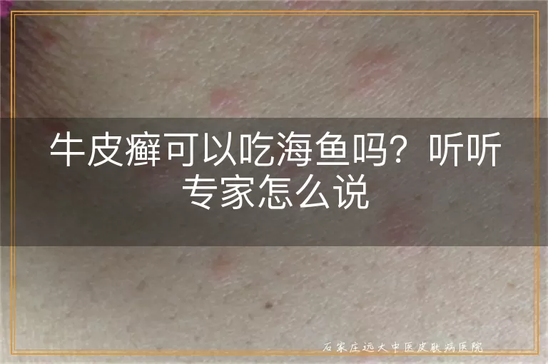 牛皮癣可以吃海鱼吗？听听专家怎么说