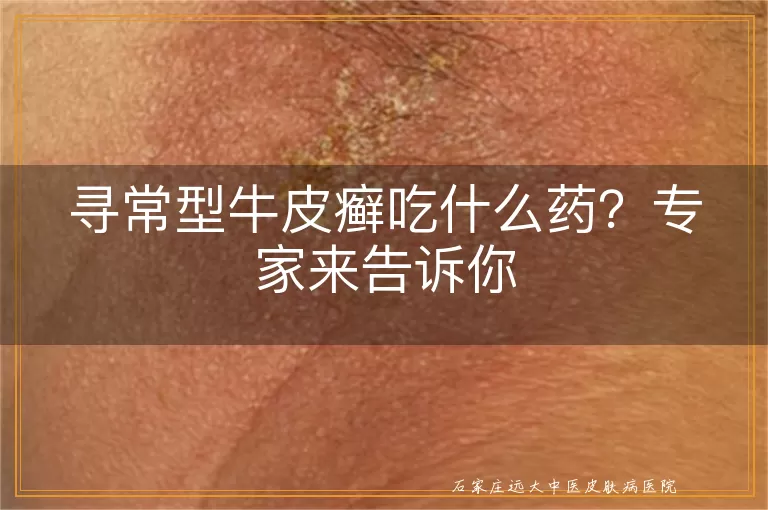 寻常型牛皮癣吃什么药？专家来告诉你