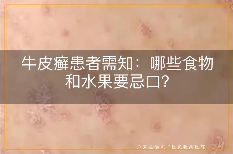 牛皮癣患者需知：哪些食物和水果要忌口？