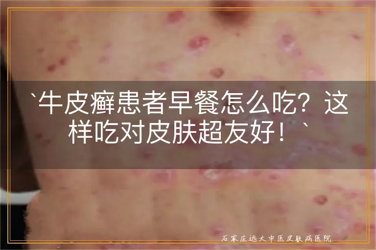 牛皮癣患者早餐怎么吃？这样吃对皮肤超友好！