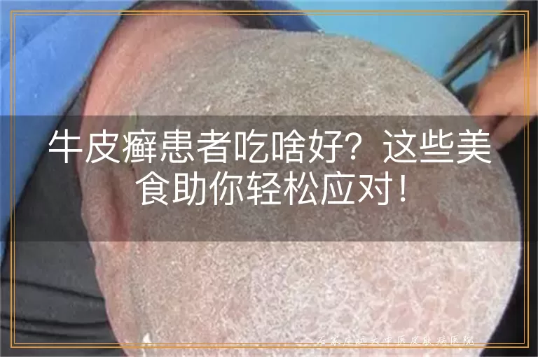 牛皮癣患者吃啥好？这些美食助你轻松应对！