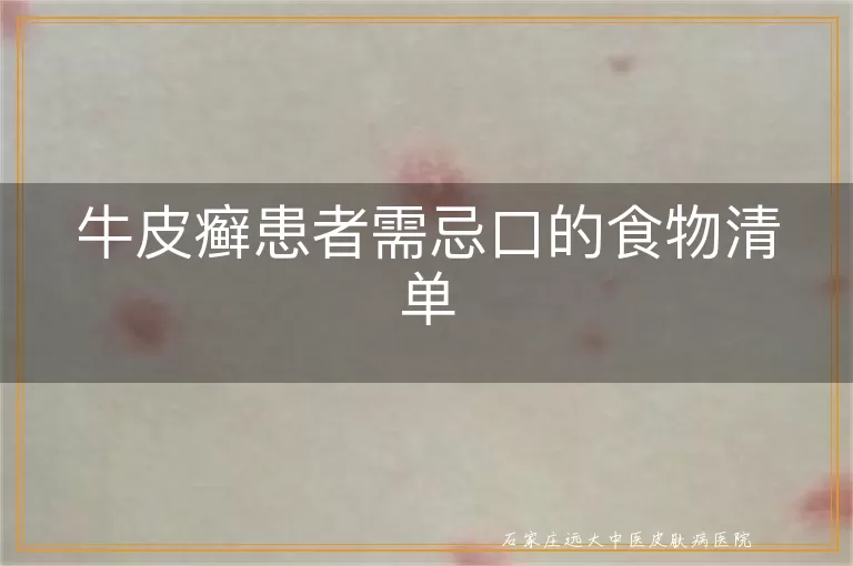 牛皮癣患者需忌口的食物清单