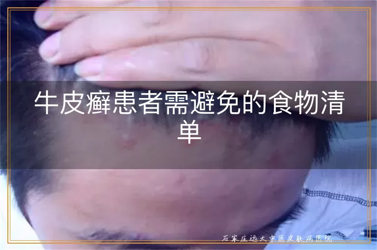 牛皮癣患者需避免的食物清单