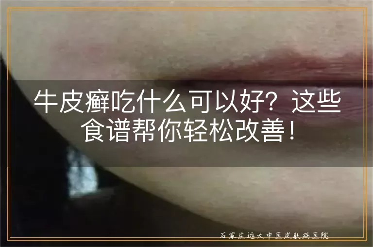 牛皮癣吃什么可以好？这些食谱帮你轻松改善！