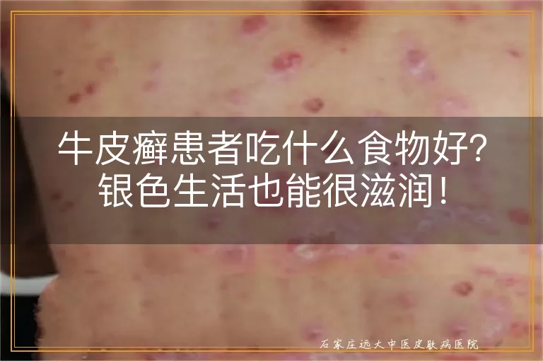 牛皮癣患者吃什么食物好？银色生活也能很滋润！