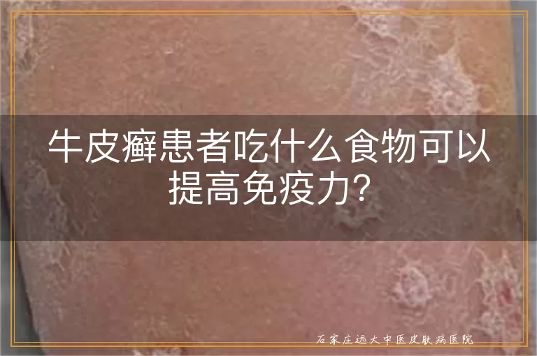 牛皮癣患者吃什么食物可以提高免疫力？