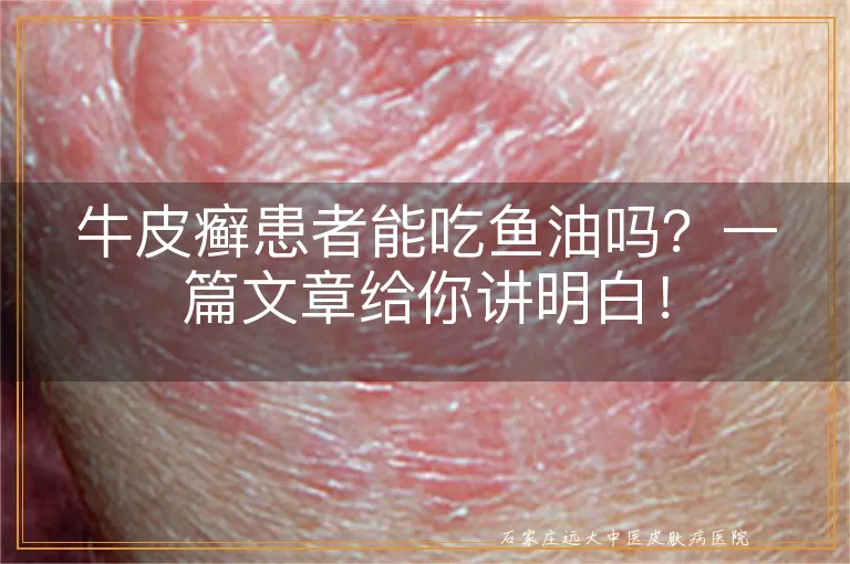 牛皮癣患者能吃鱼油吗？一篇文章给你讲明白！