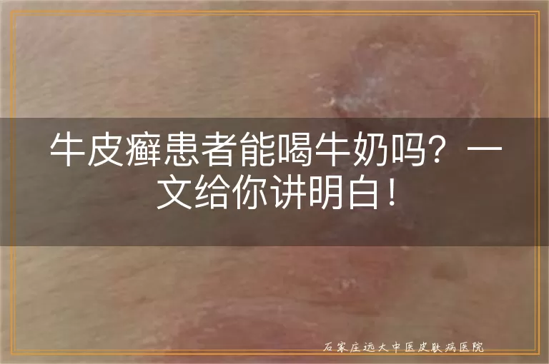 牛皮癣患者能喝牛奶吗？一文给你讲明白！