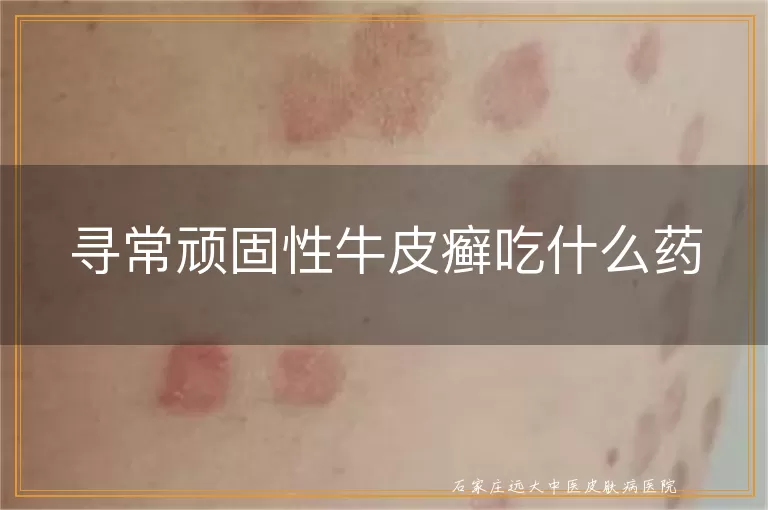 寻常顽固性牛皮癣吃什么药