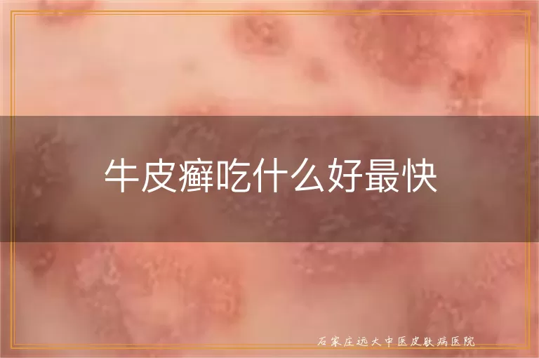 牛皮癣吃什么好最快