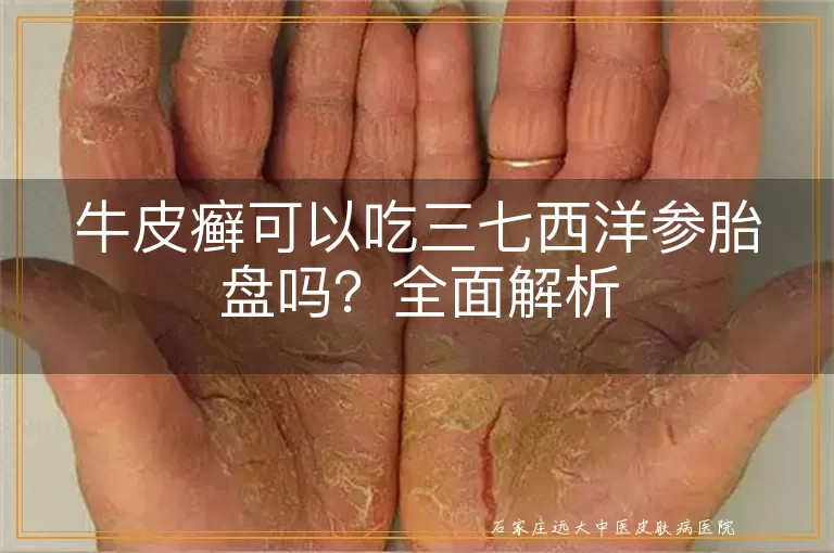 牛皮癣可以吃三七西洋参胎盘吗？全面解析