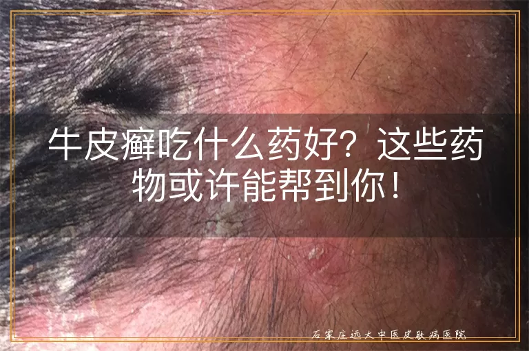 牛皮癣吃什么药好？这些药物或许能帮到你！