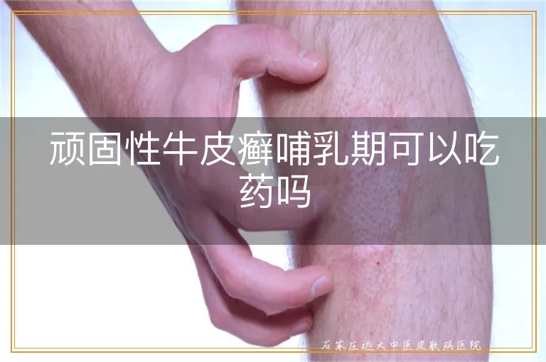 顽固性牛皮癣哺乳期可以吃药吗