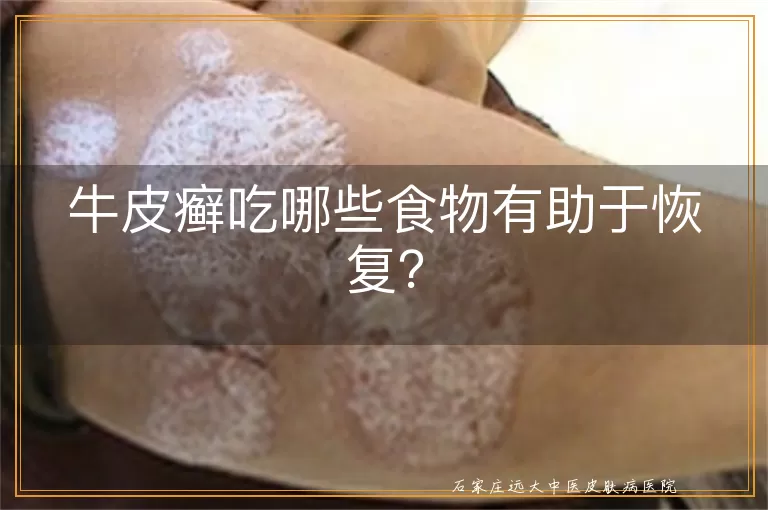 牛皮癣吃哪些食物有助于恢复？