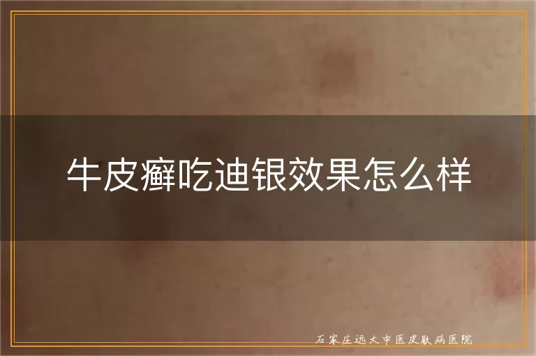 牛皮癣吃迪银效果怎么样