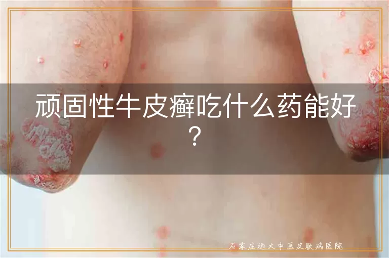 顽固性牛皮癣吃什么药能好？