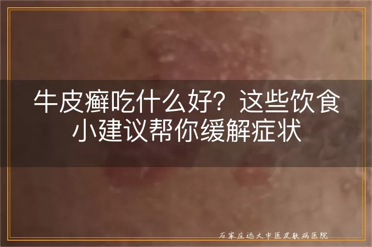 牛皮癣吃什么好？这些饮食小建议帮你缓解症状