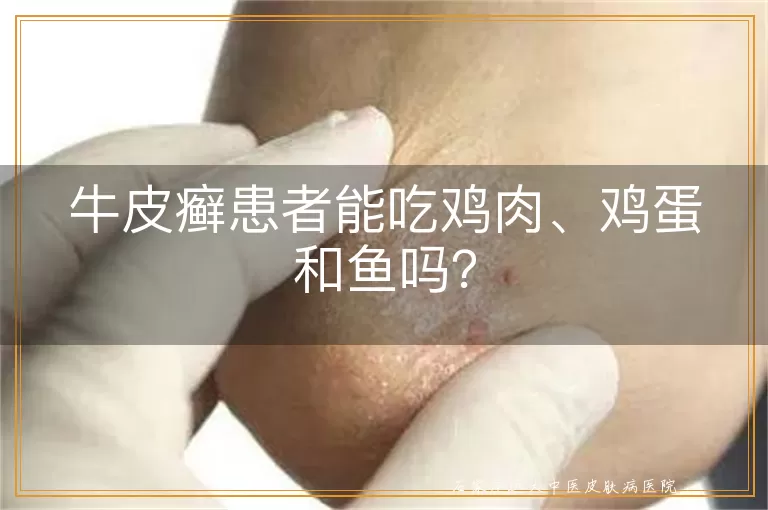 牛皮癣患者能吃鸡肉、鸡蛋和鱼吗？