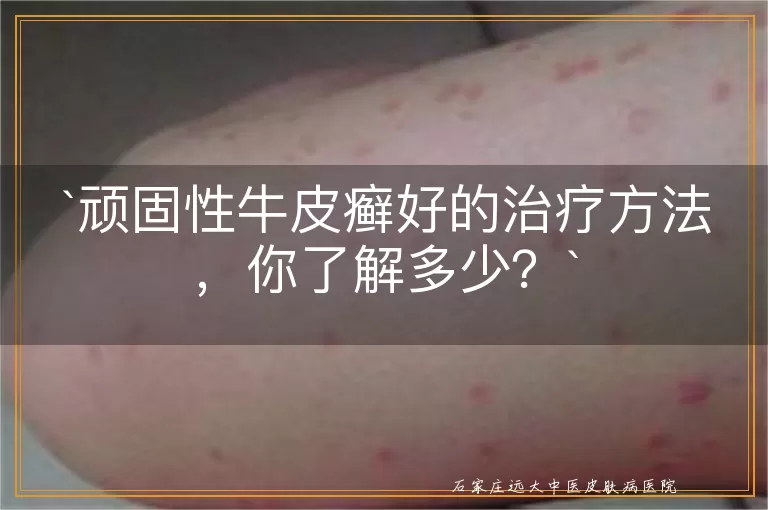 顽固性牛皮癣好的治疗方法，你了解多少？