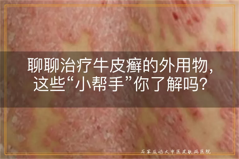 聊聊治疗牛皮癣的外用物，这些“小帮手”你了解吗？