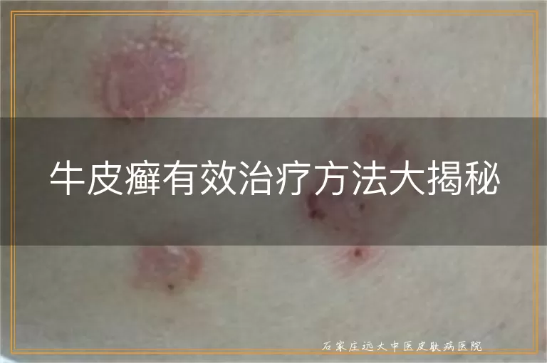 牛皮癣有效治疗方法大揭秘