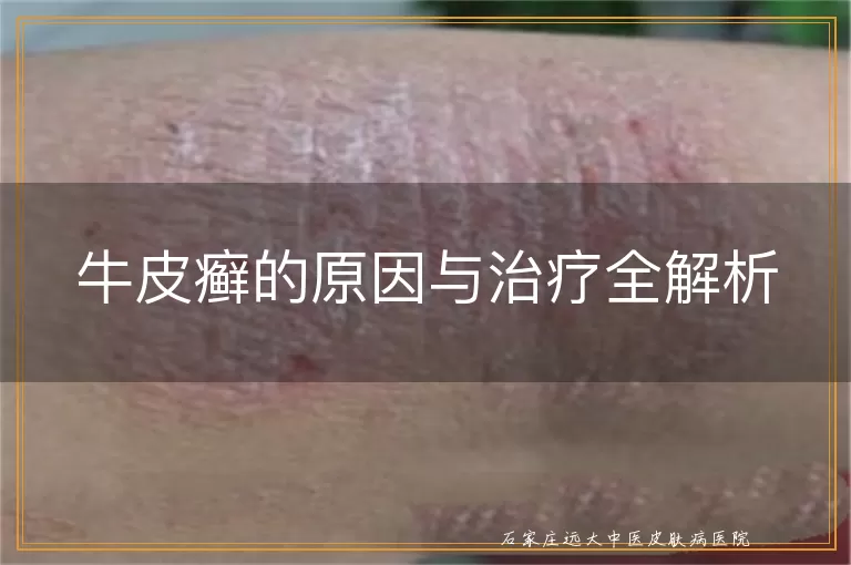 牛皮癣的原因与治疗全解析