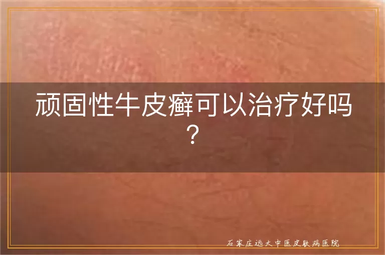 顽固性牛皮癣可以治疗好吗？