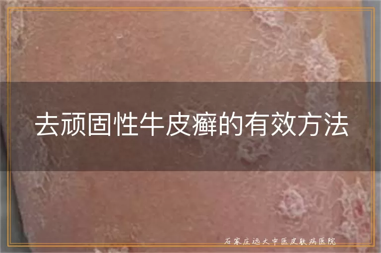 去顽固性牛皮癣的有效方法