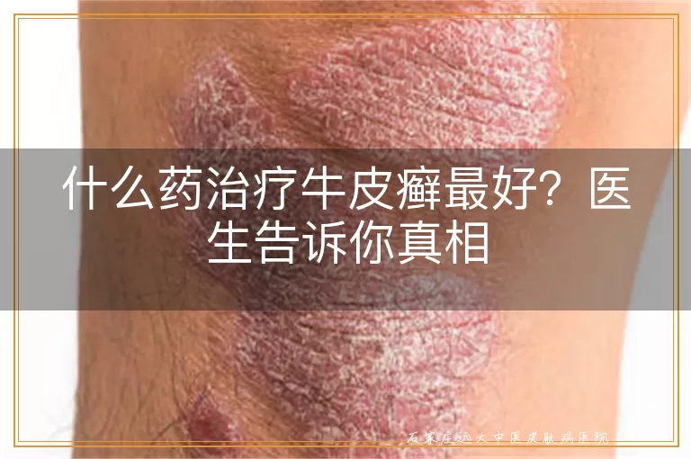 什么药治疗牛皮癣最好？医生告诉你真相