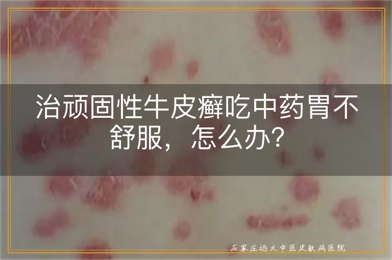 治顽固性牛皮癣吃中药胃不舒服，怎么办？