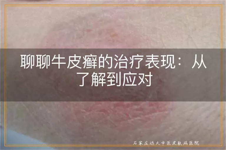 聊聊牛皮癣的治疗表现：从了解到应对