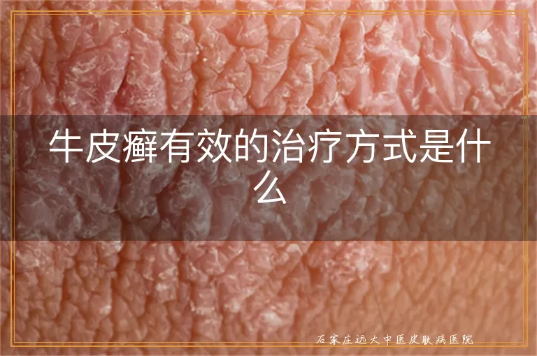 牛皮癣有效的治疗方式是什么