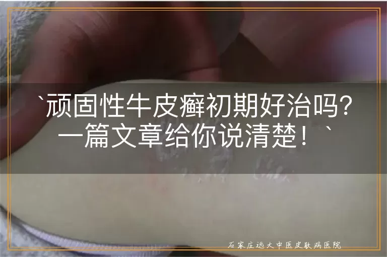 顽固性牛皮癣初期好治吗？一篇文章给你说清楚！