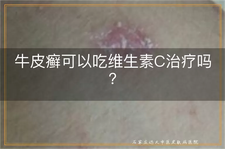 牛皮癣可以吃维生素C治疗吗？