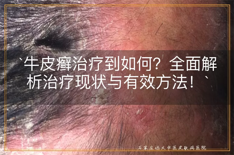 牛皮癣治疗到如何？全面解析治疗现状与有效方法！