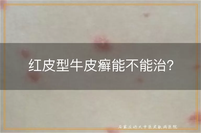 红皮型牛皮癣能不能治？