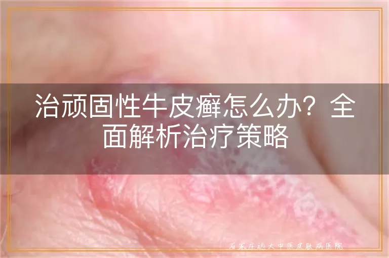 治顽固性牛皮癣怎么办？全面解析治疗策略